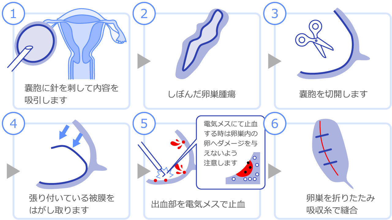 チョコレート嚢胞摘出手術の実際