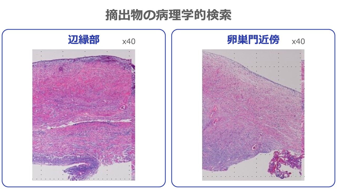 摘出物の病理学的検索