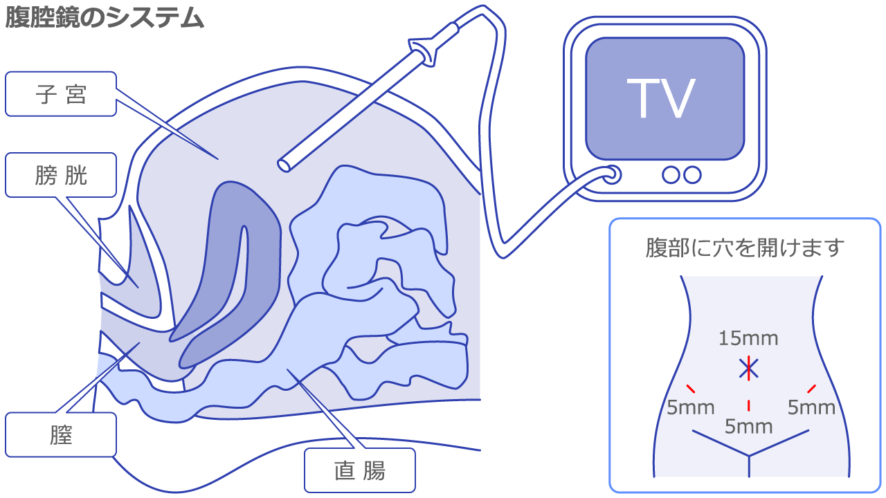 腹腔鏡手術